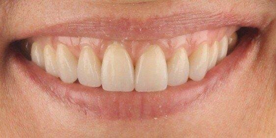 An upgraded smile with veneers