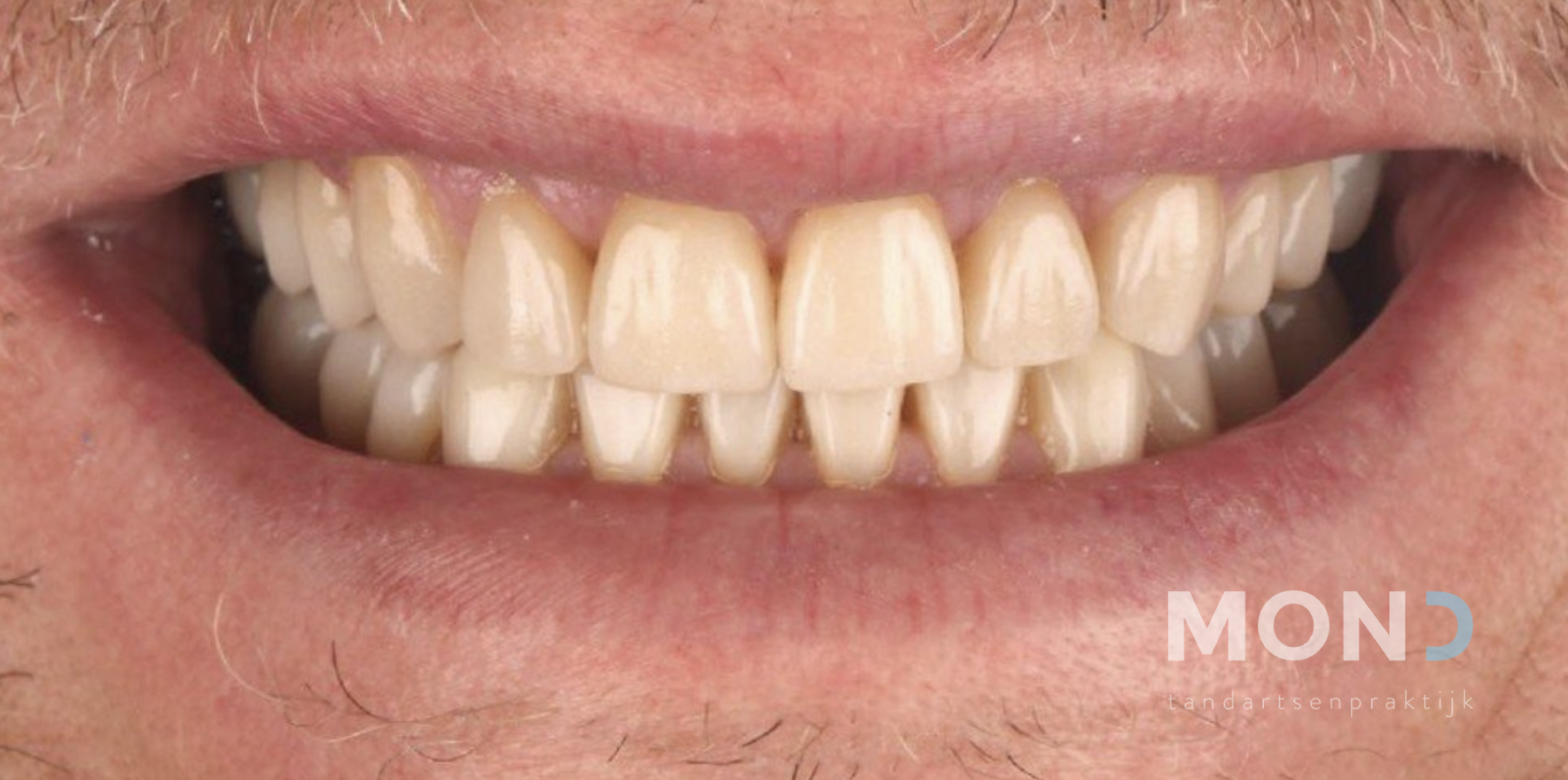 Repair with crowns and veneers after nail biting