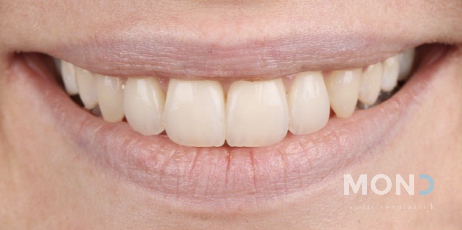 Een vollere lach met orthodontie