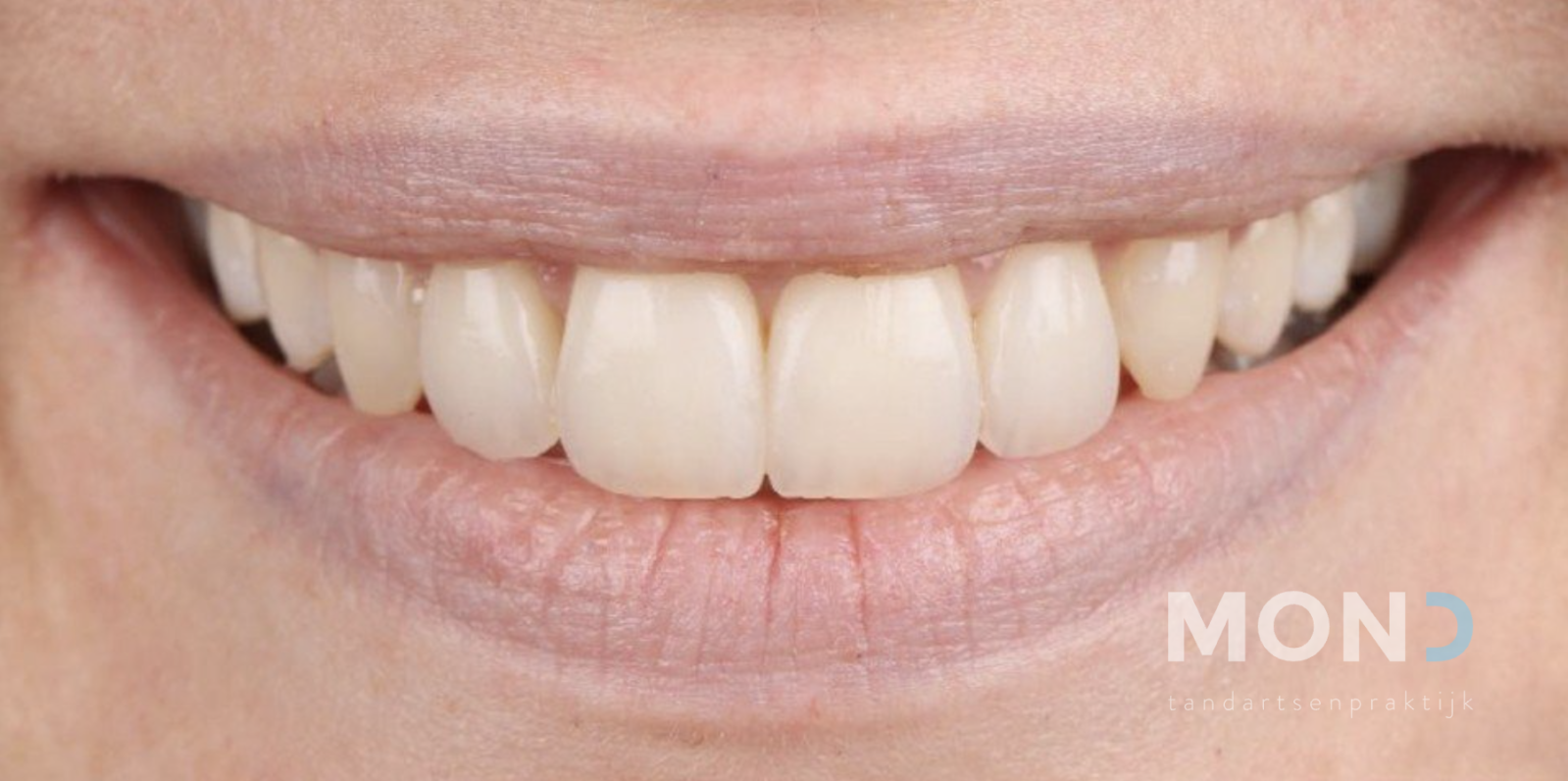 A fuller smile with orthodontics