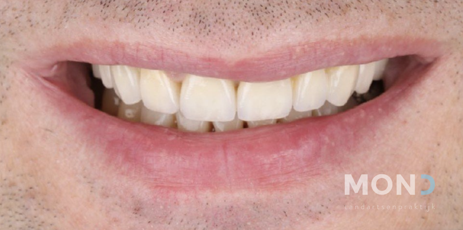 Combination of veneers with porcelain and composite