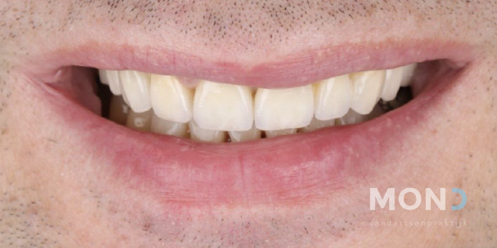 Combinatie van veneers met porselein en composiet