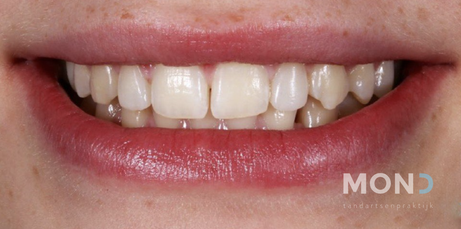 Restauration des petites dents coniques grâce à la construction en composite