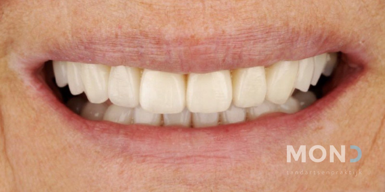 Better lip support thanks to new veneers