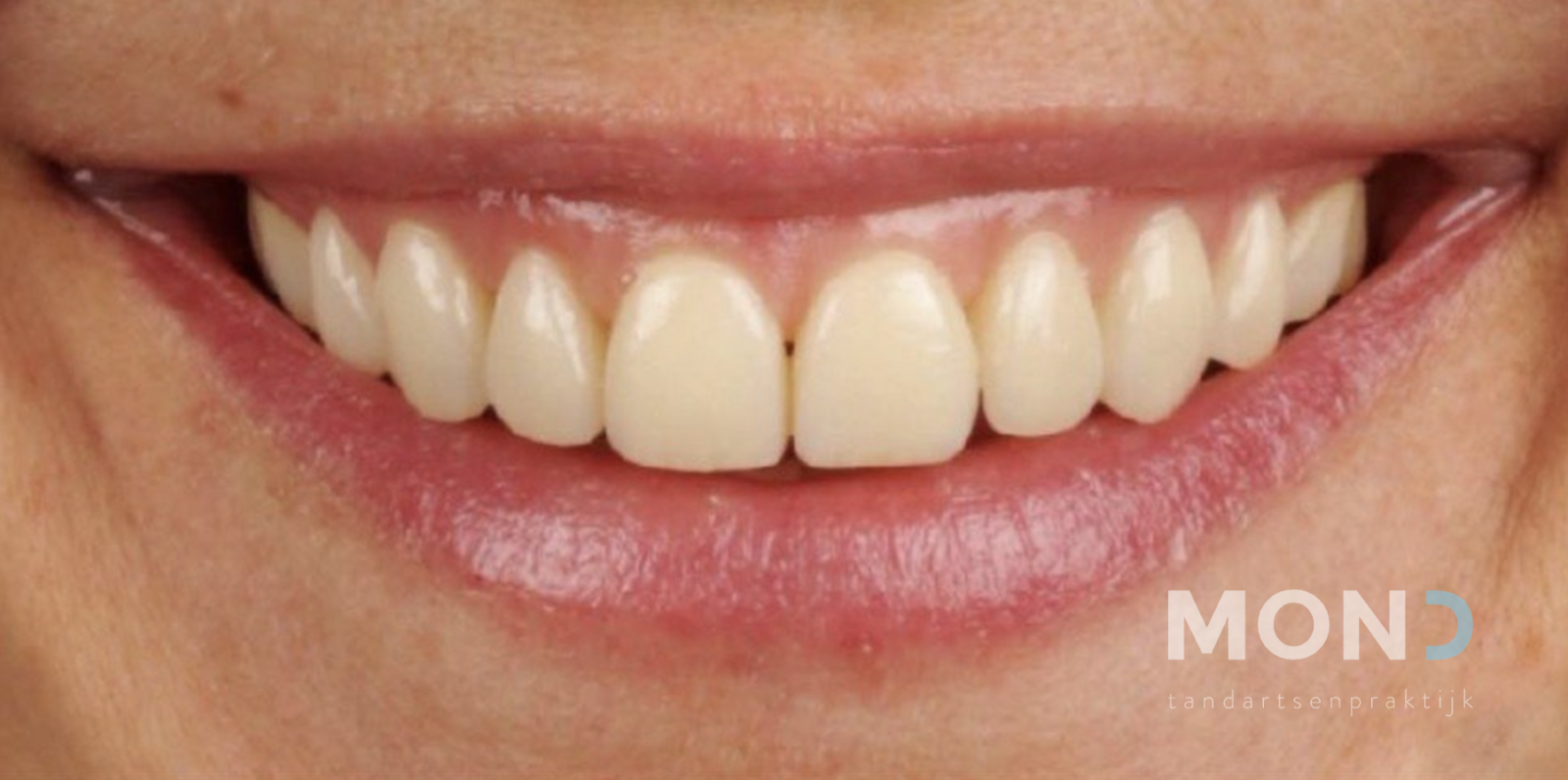 Gum surgery for a younger smile
