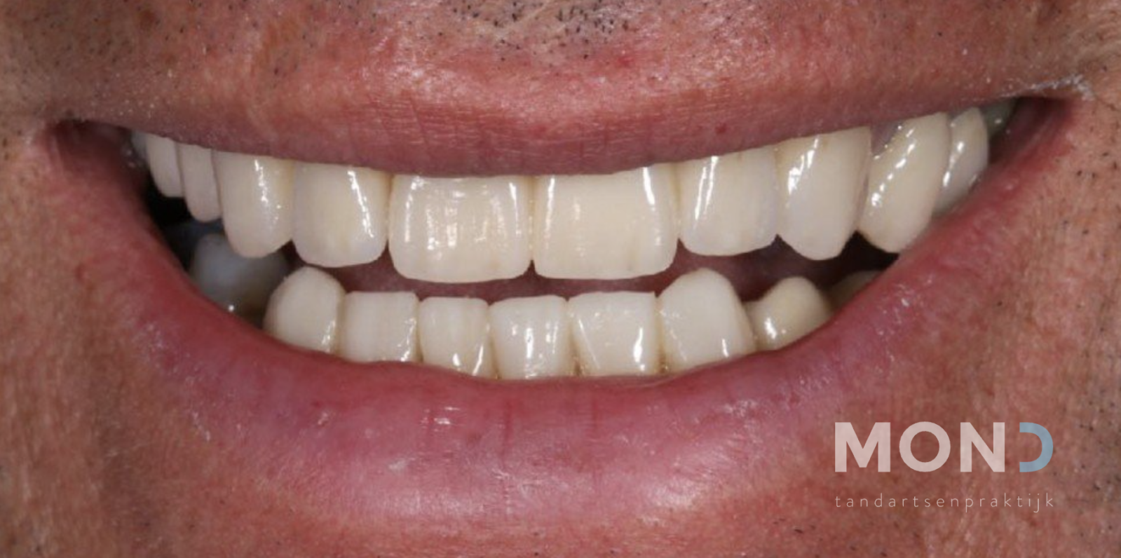 Implants et couronnes pour une bouche fonctionnelle