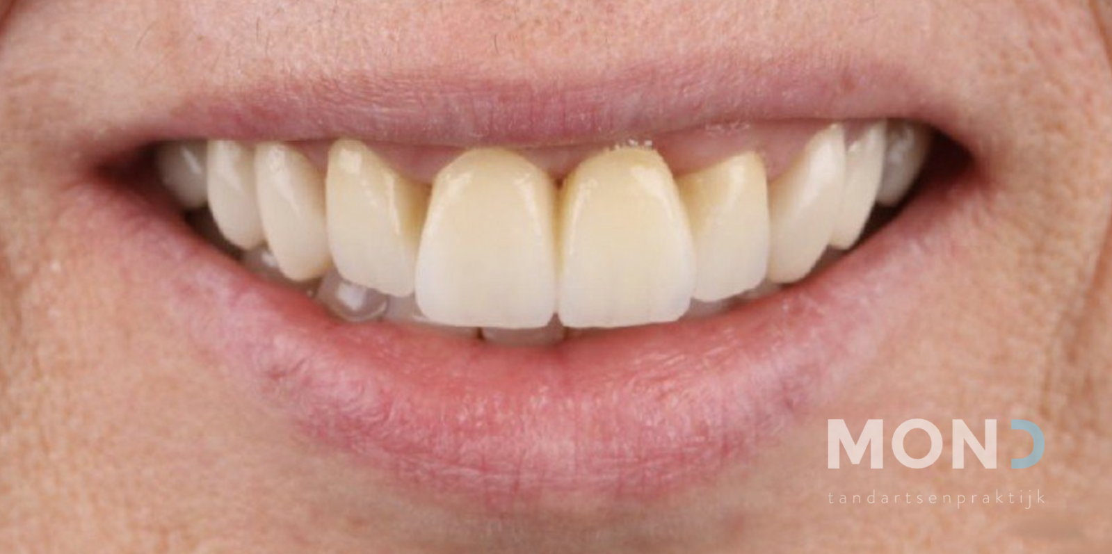 Bridge work, bleaching and veneers to correct tooth position and smile