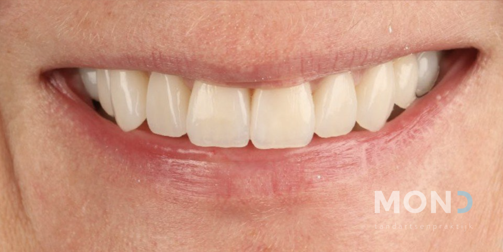 Veneers to correct position and colour