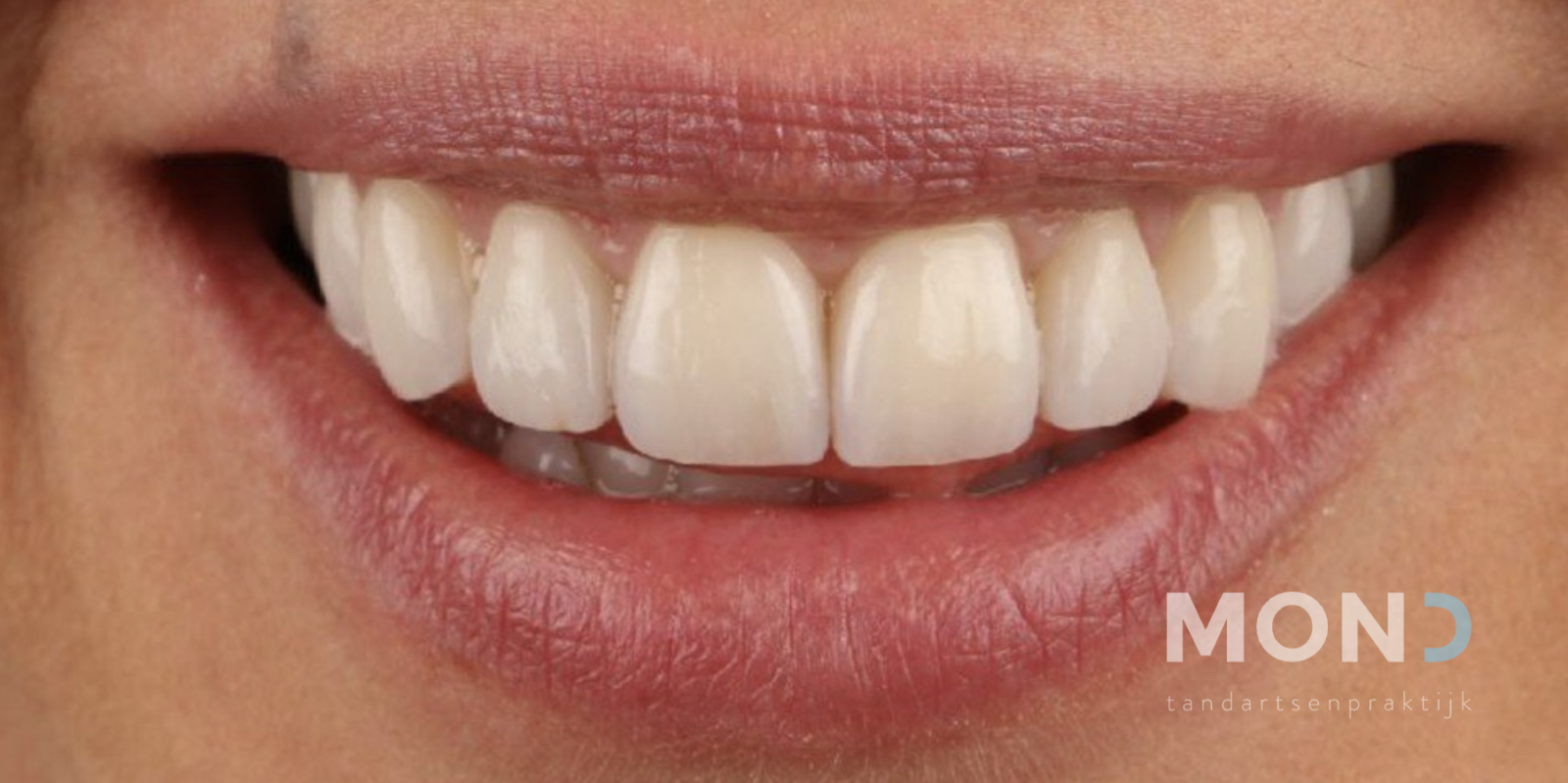 Replacing old composite veneers with porcelain