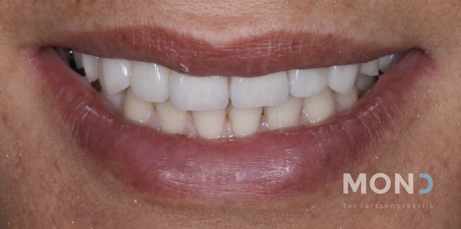 Beetcorrectie en herstel van slijtage met orthodontie en veneers