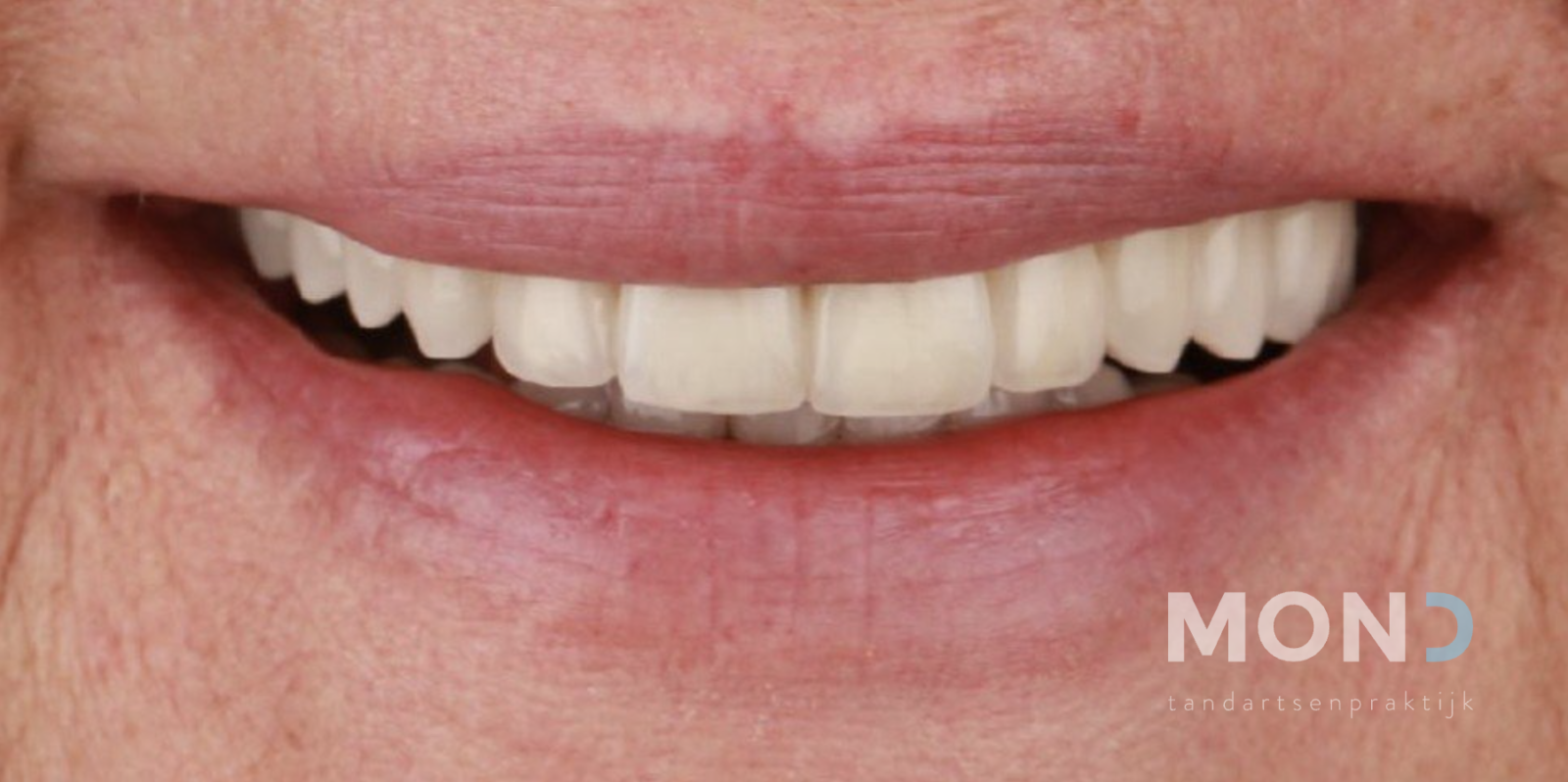 Completing the missing teeth with veneers and crowns