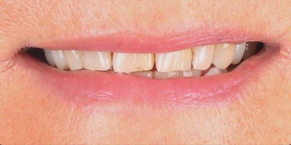 Crossbite repair with veneers