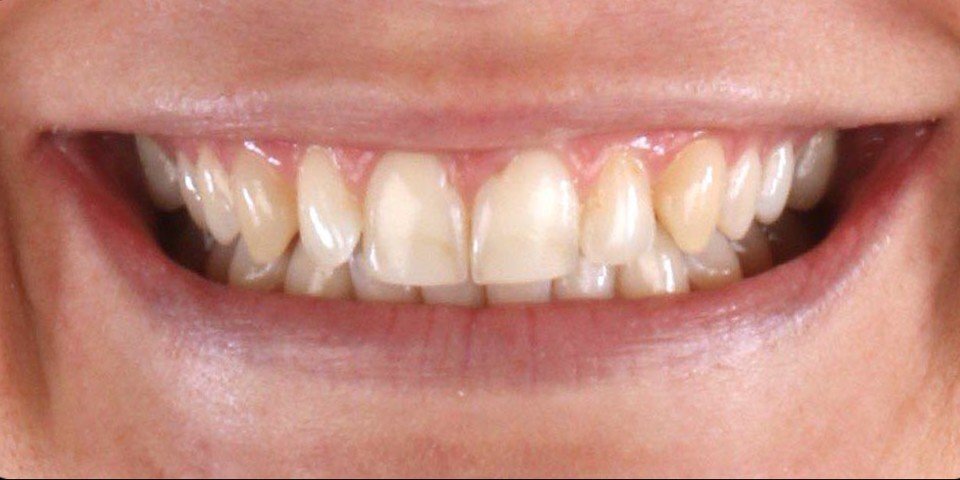 A fuller smile with orthodontics