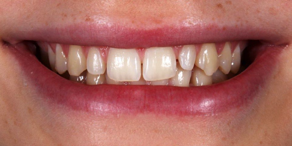 Restauration des petites dents coniques grâce à la construction en composite