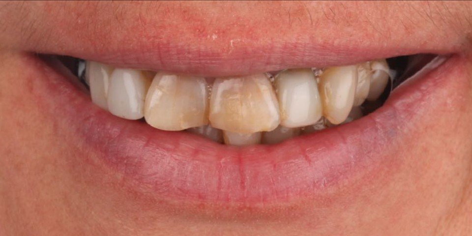 New crowns for a healthier mouth