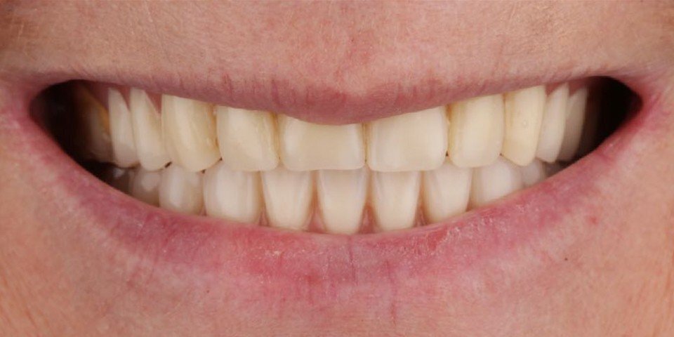 Prothèses dentaires amovibles neuves