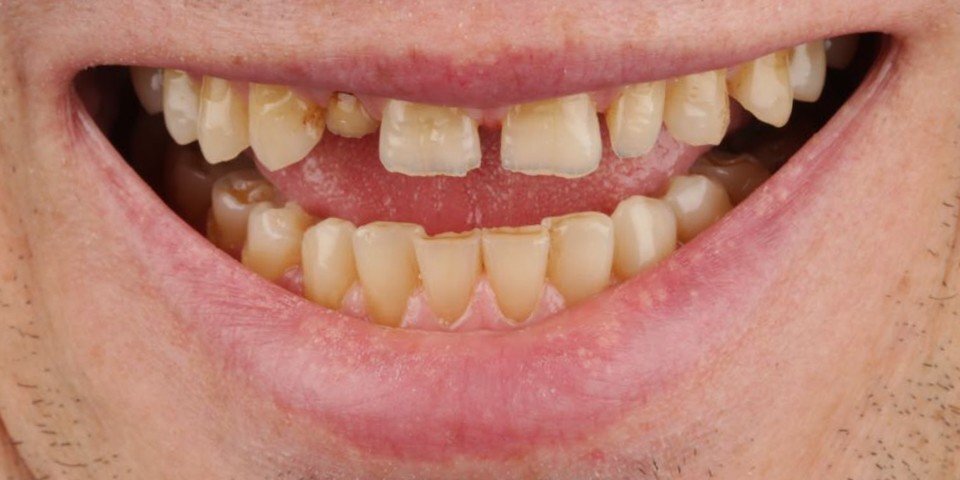 Crowns for restoration of chewing function
