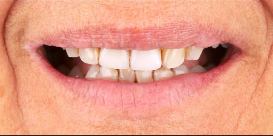 Better lip support thanks to new veneers