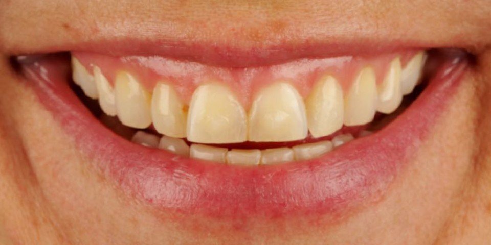 Gum surgery for a younger smile
