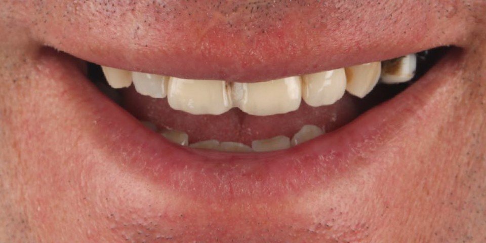 Implants et couronnes pour une bouche fonctionnelle