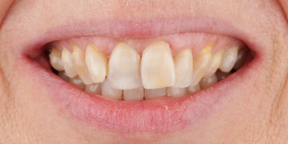Bridge work, bleaching and veneers to correct tooth position and smile