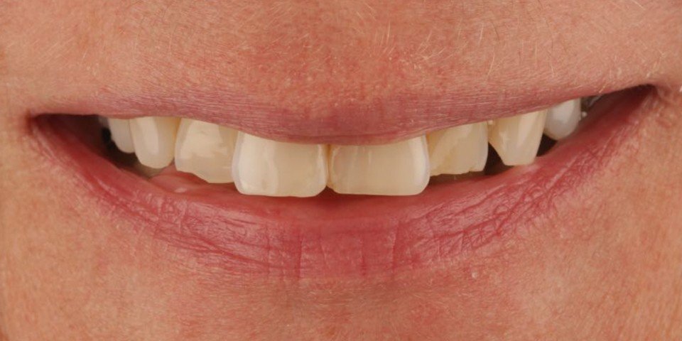 Veneers to correct position and colour