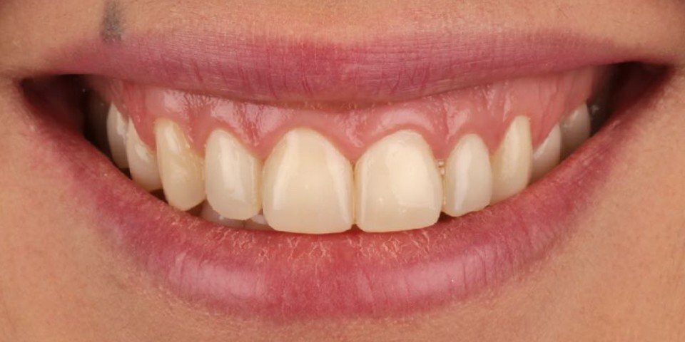 Replacing old composite veneers with porcelain
