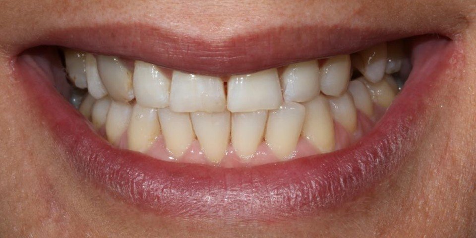 Bite correction and repair of wear with orthodontics and veneers