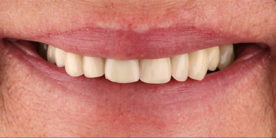 Completing the missing teeth with veneers and crowns